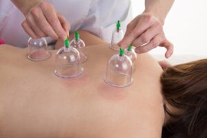 cupping therapy