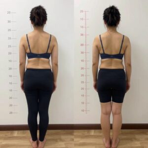 Improved surgical outcomes through pre-operative physiotherapy rehabilitation